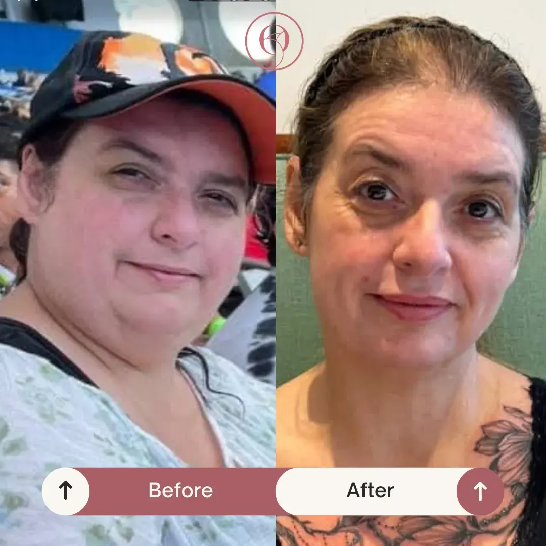 Pérdida de peso médica antes y después