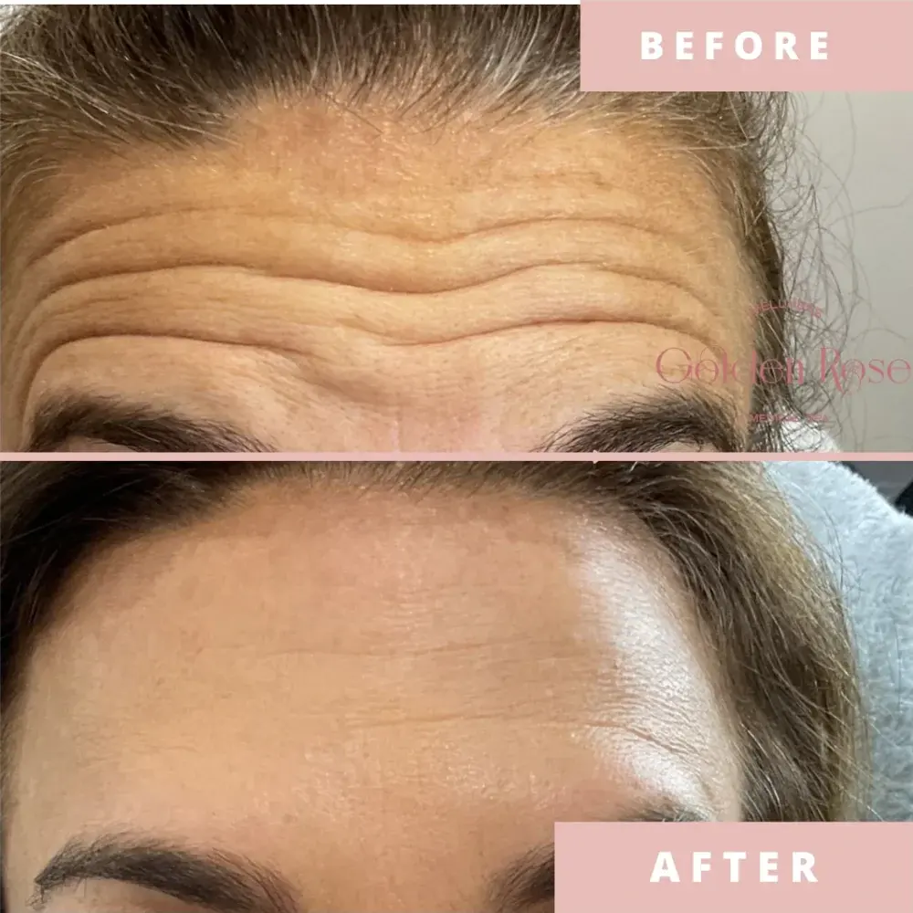 Botox antes y después, líneas profundas de la frente suavizadas