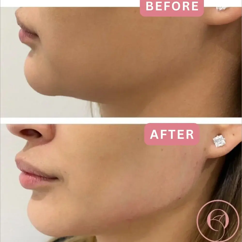 Relleno de mandíbula antes y después, perfil lateral