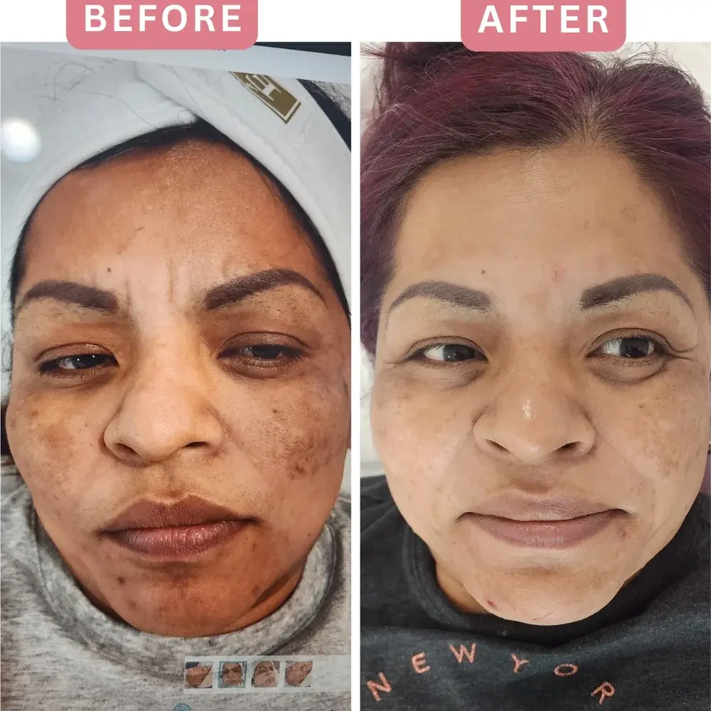 Melasma treatment before and after
