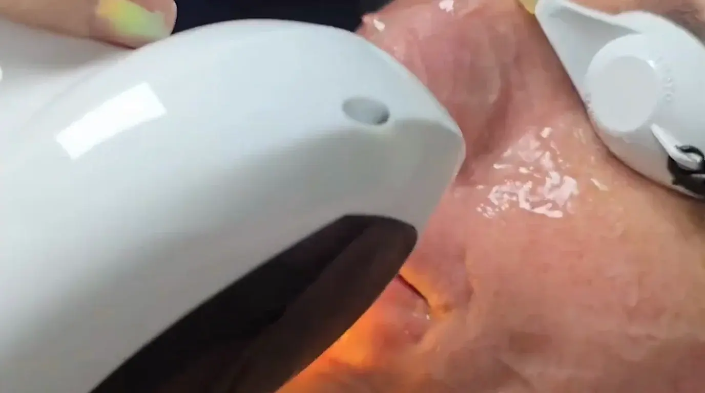 Laser Rosacea Treatment
